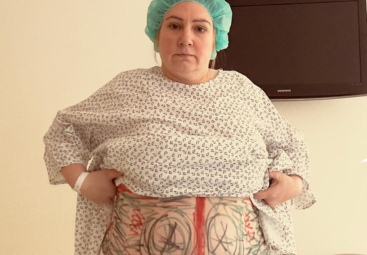 Lipœdème au ventre : témoignage de Linda & explications médicales