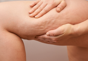 Cellulite : médecine, MTC et Ayurveda | LIPOELASTIC